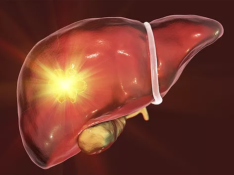 Cancer liver tumor treatment