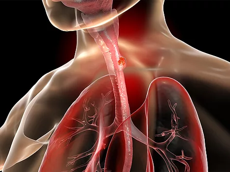 Esophageal cancer illustration