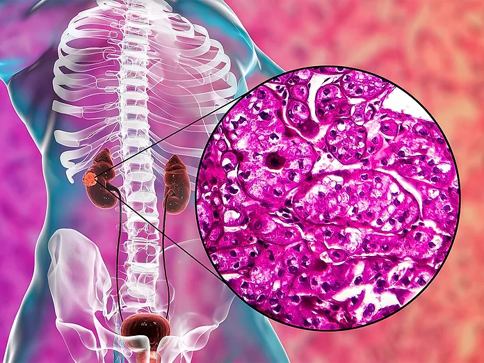 kidney-cancer-micrograph.webp?