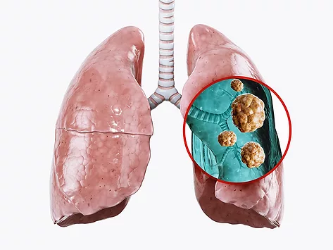 Lung cancer tumor