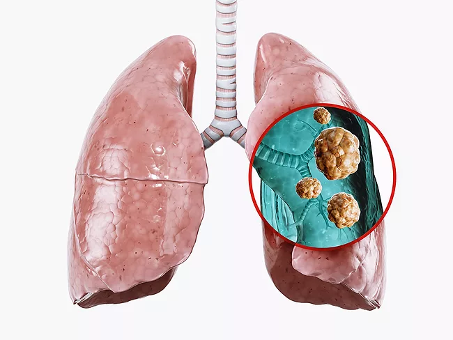 Illustration of lungs with cancer inset
