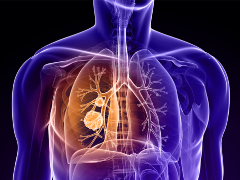 Lung cancer illustration