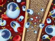 Multiple myeloma art concept