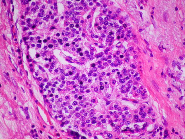 Pathology image of neuroendocrine tumor