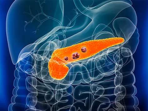 Pancreatic cancer pancreas 3d