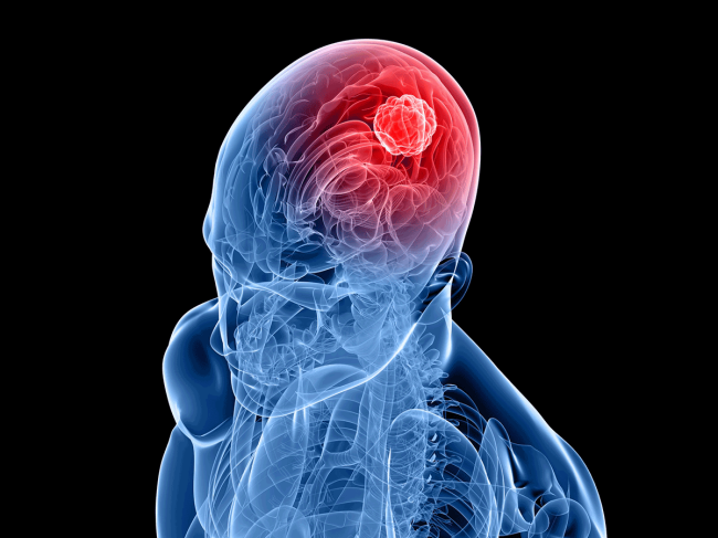 3D-head-brain-cancer