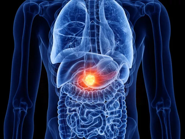3D illustration of pancreatic cancer