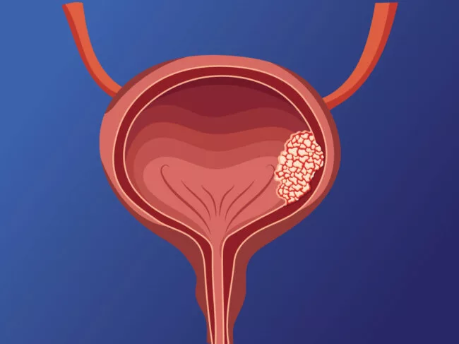 Illustration showing cross-section of bladder with tumor on bladder wall