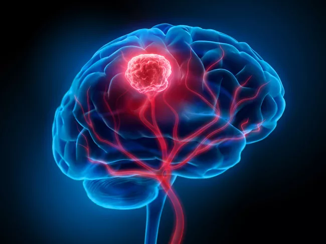 Brain tumor illustration