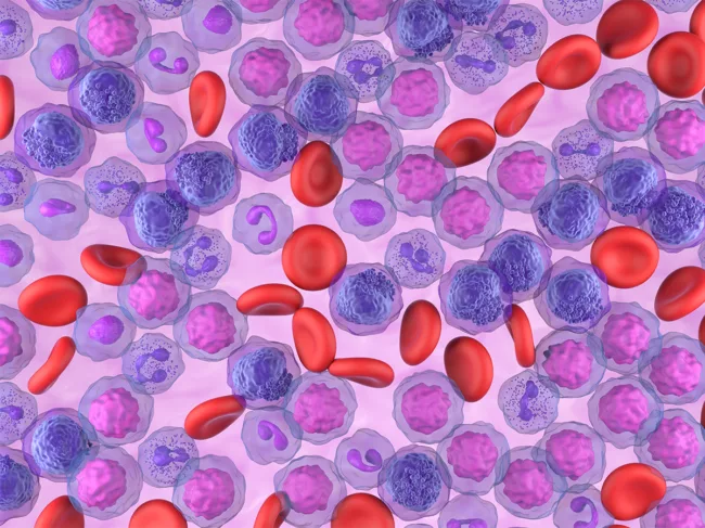 Illustration of acute myeloid leukemia (AML) cells in the blood stream