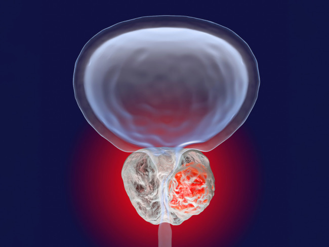 3D illustration showing presence of tumor inside prostate gland 
