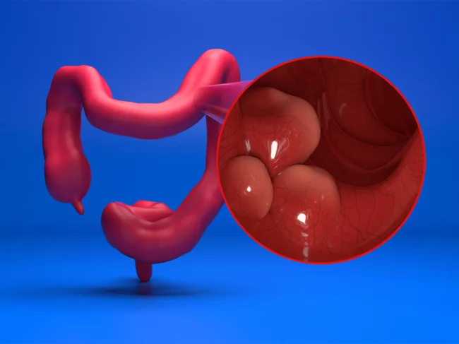 Illustration of colon with inset showing cancer