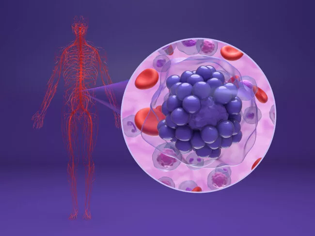 Diffuse large B-cell lymphoma - isometric view