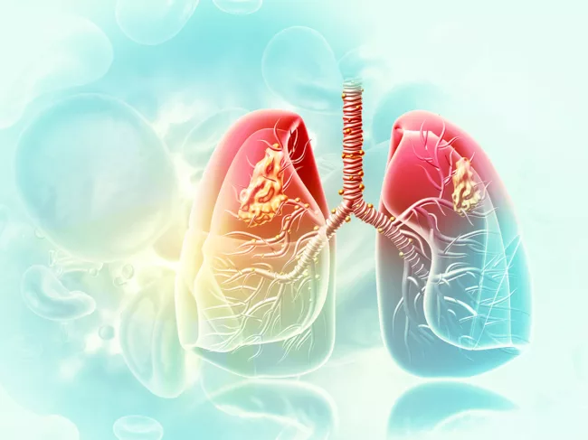 Medical Illustration showing lung cancer 