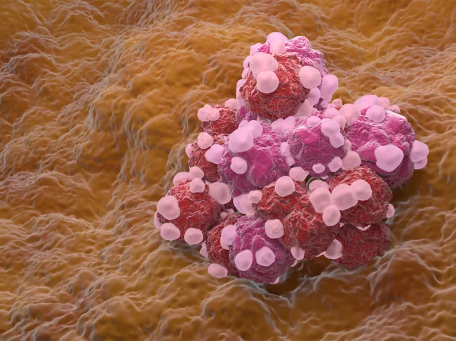 Illustration of a cluster of ovarian cancer cells