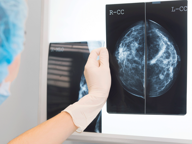 breast-cancer-mammogram.png