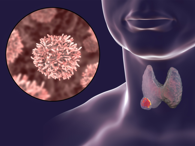 Anatomy illustration of thyroid, tumor, cancer cells
