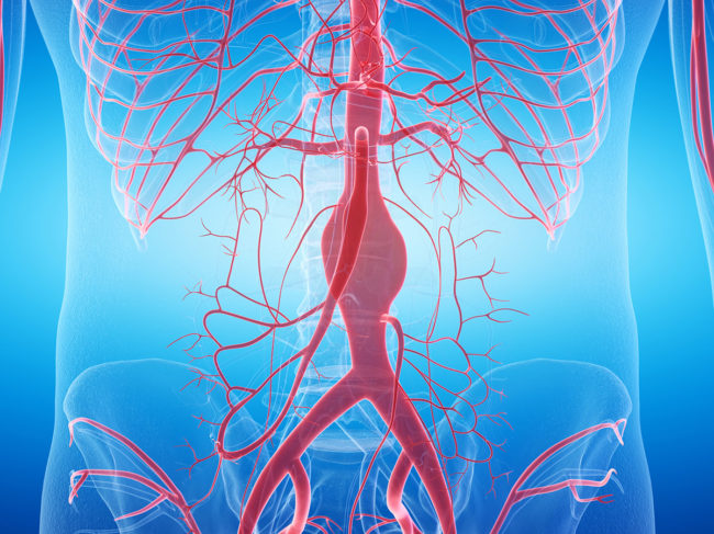 Illustration of abdominal aortic aneurysm