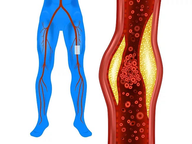 Peripheral artery disease in leg artery