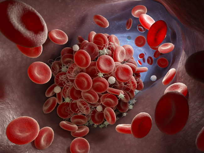 Illustration of clot forming in blood vessel