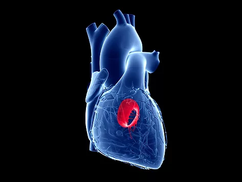Cardio heart mitral valve