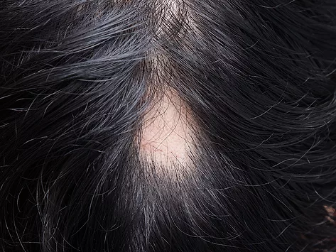Alopecia