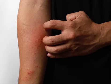 Close up dermatitis on the skin