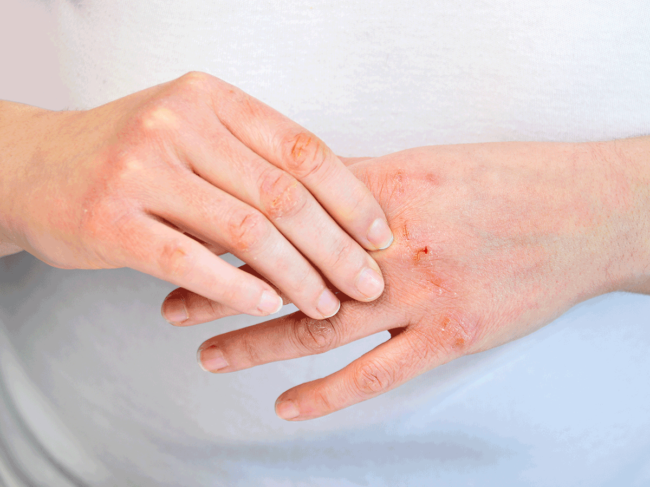 Skin irritation on hands