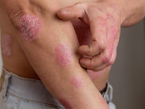 Close up of hand scratching arm with psoriasis patches