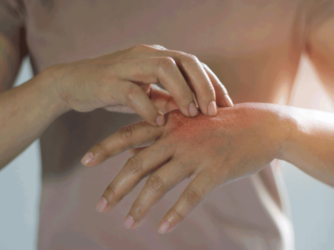Skin irritation on hands