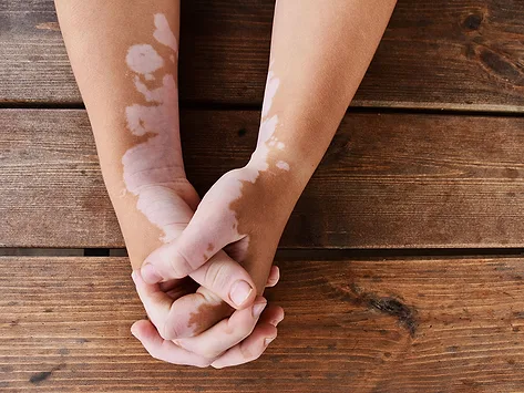 Hands and arms with vitiligo
