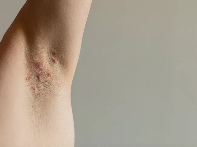 Hidradenitis suppurativa abscesses in the armpit
