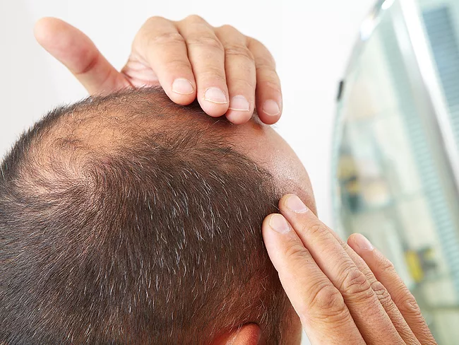 Male hair loss
