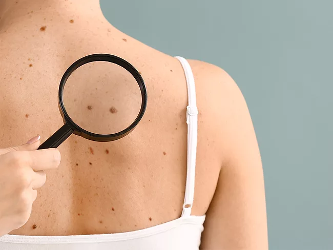 Photo of magnifying glass inspecting moles on person's back