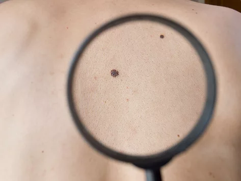 Skin through magnifier