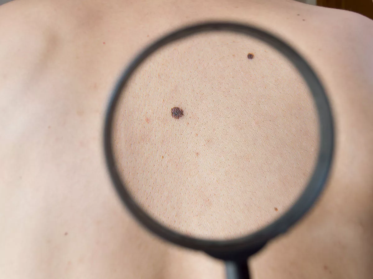 Replimune’s RP-1 for melanoma wins over FDA adcom