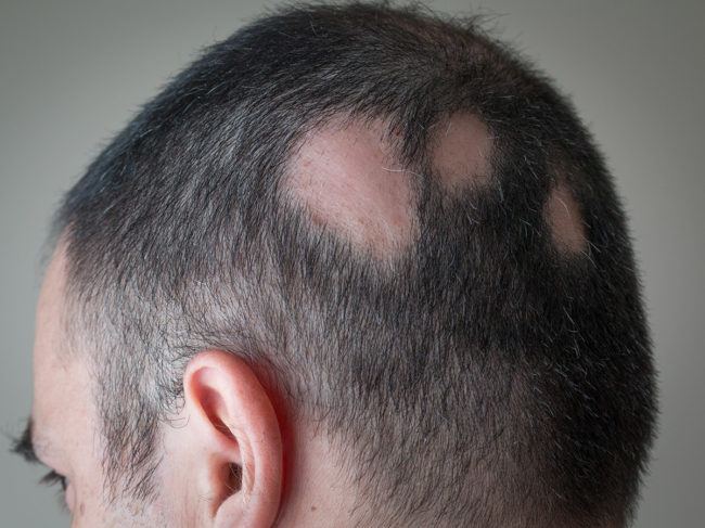 Hair loss patches on head