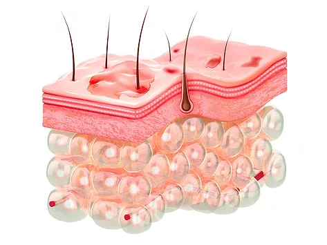 Atopic dermatitis eczema skin