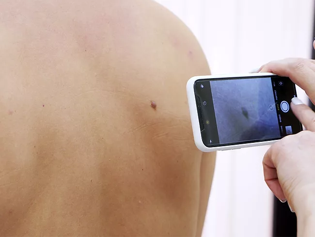 Taking photo of mole with smart phone