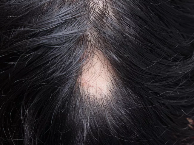 Alopecia - hair loss 