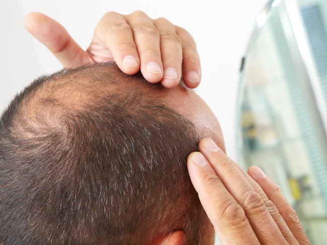 Male hair loss