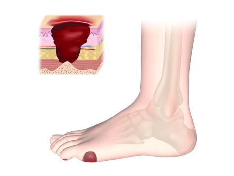 Illustration of diabetic foot ulcer, cross section of wound