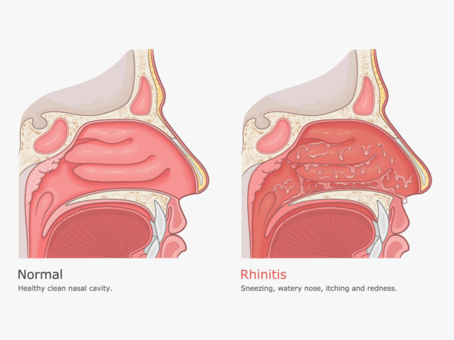 Illustrations of nasal cavities comparing rhinitis to normal.