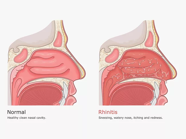 Illustrations of nasal cavities comparing rhinitis to normal.