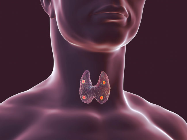 3D illustration of thyroid in human body with parathyroid glands highlighted