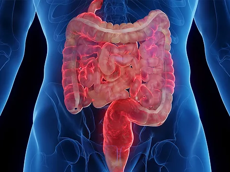 Gastrointestinal ibd crohns