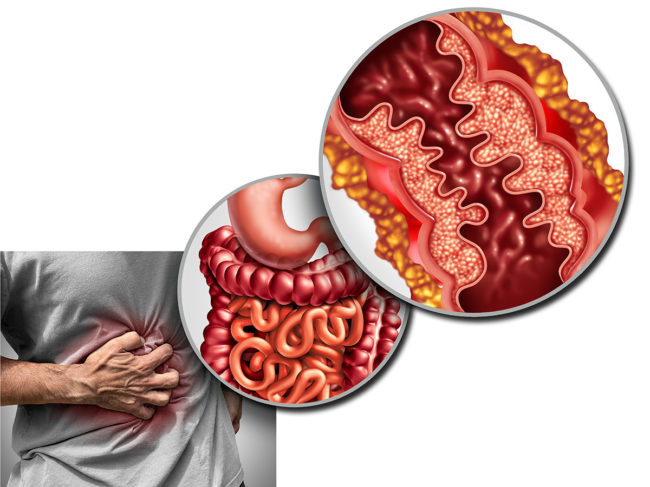 Art concept for inflammation in the intestines
