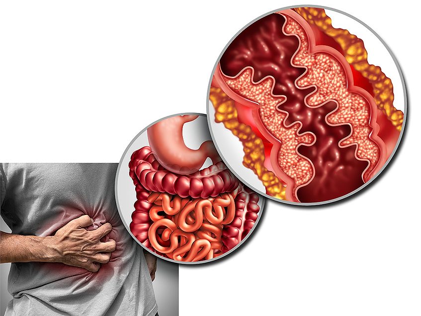 Kymera’s IRF5 degrader shows potential in IBD treatment