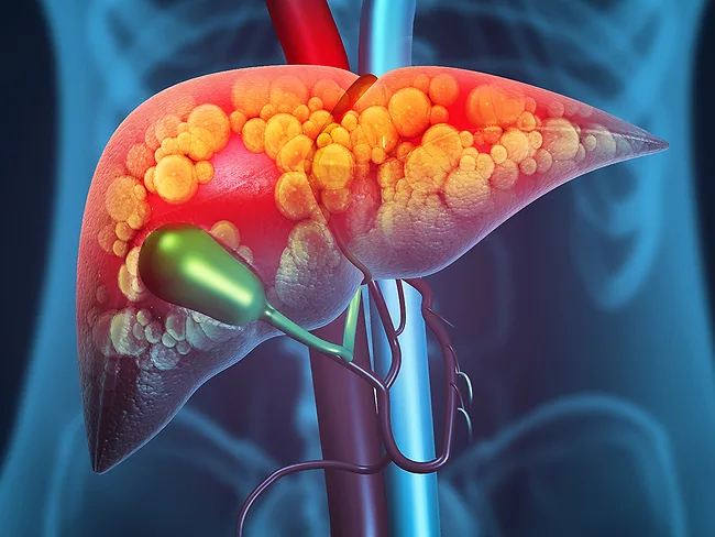 Art concept for liver damage, such as fatty liver, fibrosis or cirrhosis