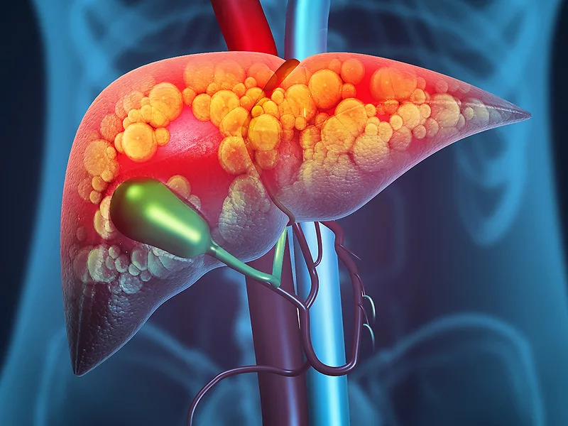 D&D's zabopegdutide shows more upbeat top-line phase II MASH data | BioWorld D&D's zabopegdutide shows more upbeat top-line phase II MASH data | BioWorld